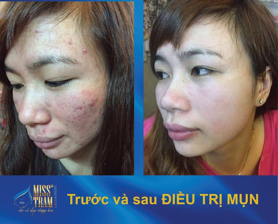 Treat Acne With Full Micro-Stimulus Technology