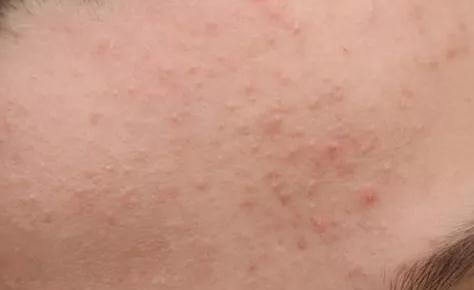 Pimples Hidden Under The Skin