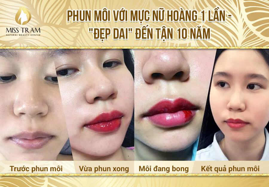 Kỹ thuật phun môi công nghệ Châu Âu không bị đau, sưng tấy