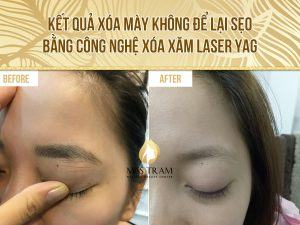 Kết quả xóa mày không để lại sẹo bằng công nghệ Laser Yag - Chị Trinh Mở mắt