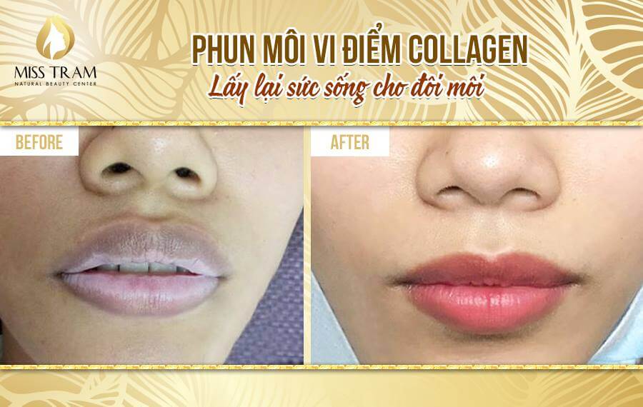 Phun Môi Collagen - Kỹ Thuật Phun Xăm Môi Hiện Đại