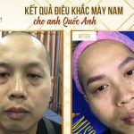 Hình Ảnh Kết Quả Điêu Khắc Mày Cho Anh Quốc Anh Nghiên cứu