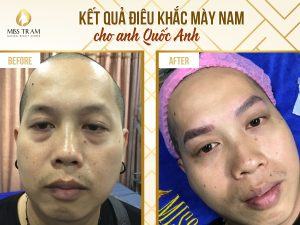 Hình Ảnh Kết Quả Điêu Khắc Mày Cho Anh Quốc Anh Tin tức