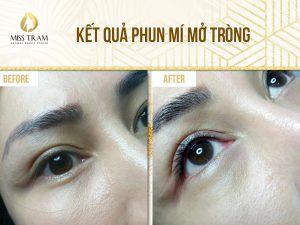 Kết quả phun mí mở tròng tại Miss Tram - Natural Beauty Center Mở mắt