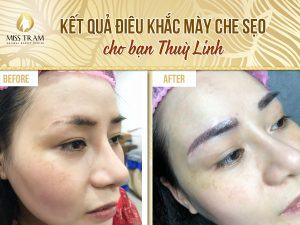 Kết quả điêu khắc mày che sẹo cho bạn Thùy Linh Tin tức