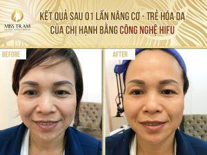 Kết quả trẻ hóa da của chị Hạnh bằng công nghệ Hifu Phổ biến