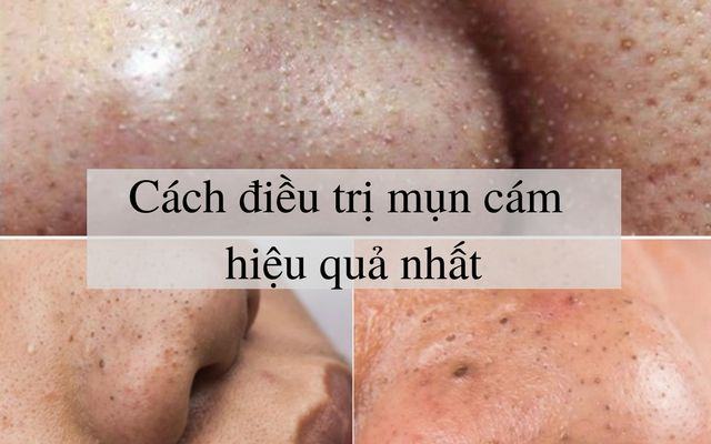 How To Treat Acne Thoroughly Notes