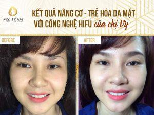 Kết quả Nâng cơ - Trẻ hóa da mặt với công nghệ Hifu Tin tức