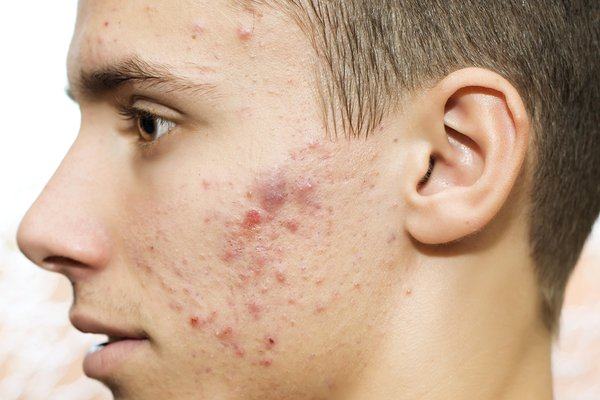 Where does hormonal acne come from?