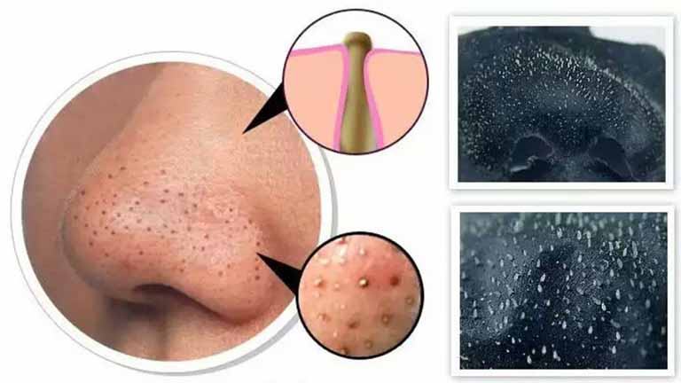 Blackheads, causes and treatment