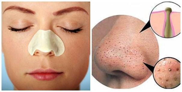 how to treat blackheads on nose