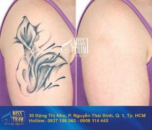 Prestigious Scarless Tattoo Removal Address in Ho Chi Minh City Possibility
