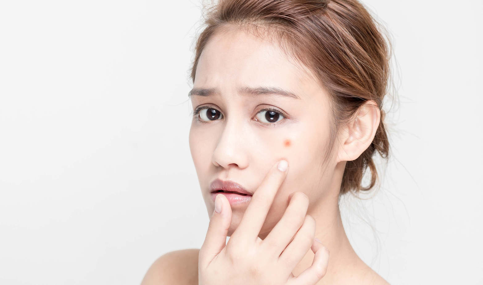 Instructions on How to Treat Callused Acne Safely Truth