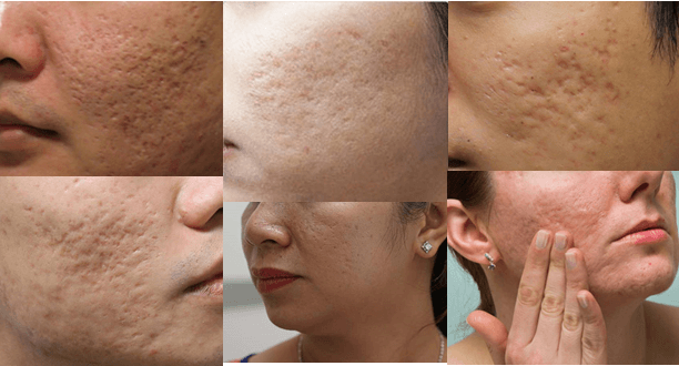 Treat pitted scars with microdermabrasion