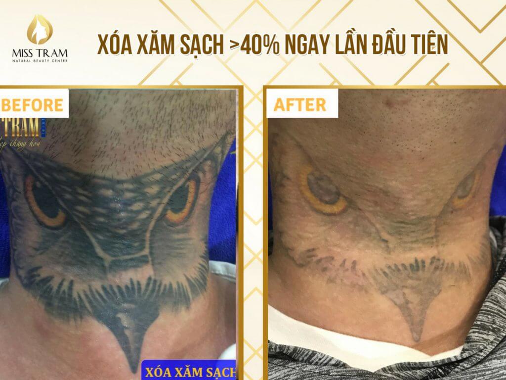 Pictures after 1 time tattoo removal, m