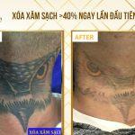 Công nghệ xóa xăm sạch trên 40% ngay lần đầu tiên Nghiên cứu