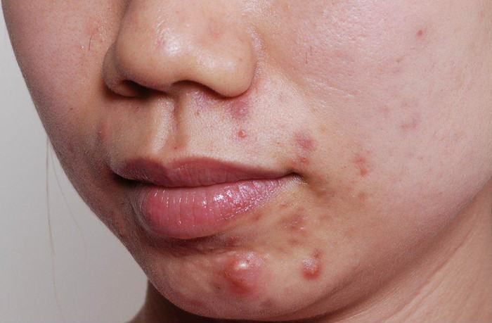 How To Treat Acne Under The Chin Effectively Up To 90% At Home Possibility