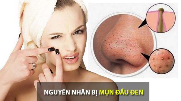 Blackheads causes and treatment