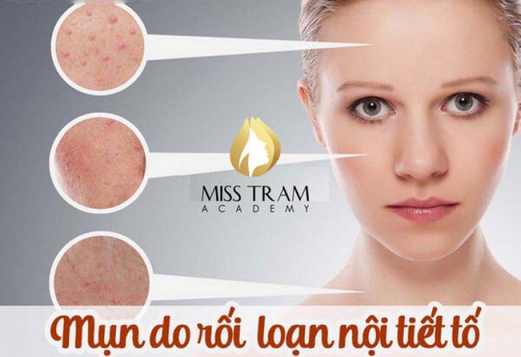 Mụn Nội Tiết Thường Mọc Ở Đâu
