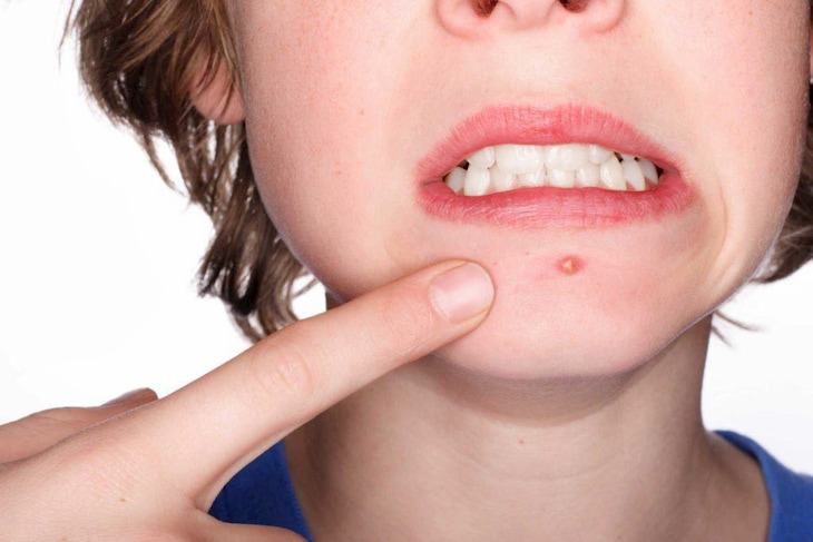 how to treat acne under the chin