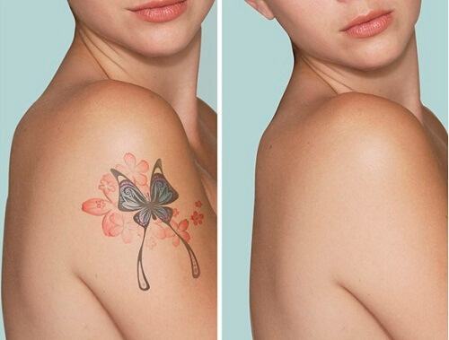 Scarless Tattoo Removal Service In Ho Chi Minh Secret