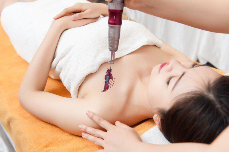 tattoo removal with laser technology