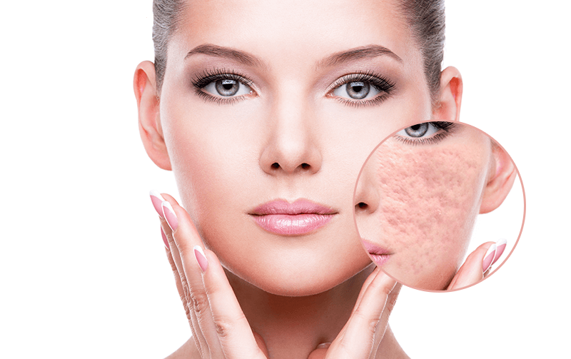 Method of Treating Pimples With Microdermabrasion Censorship Score