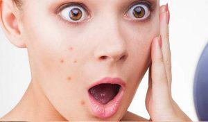 What Should I Eat For Endocrine Acne To Get Out Of The Common