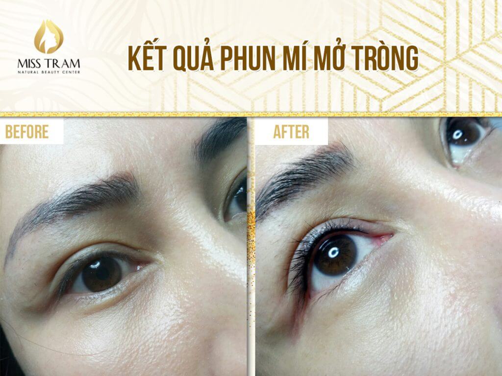 Image of eyelid spray results at Miss Tram
