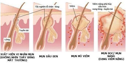 Nguyên nhân mụn ít nhưng để lại thâm