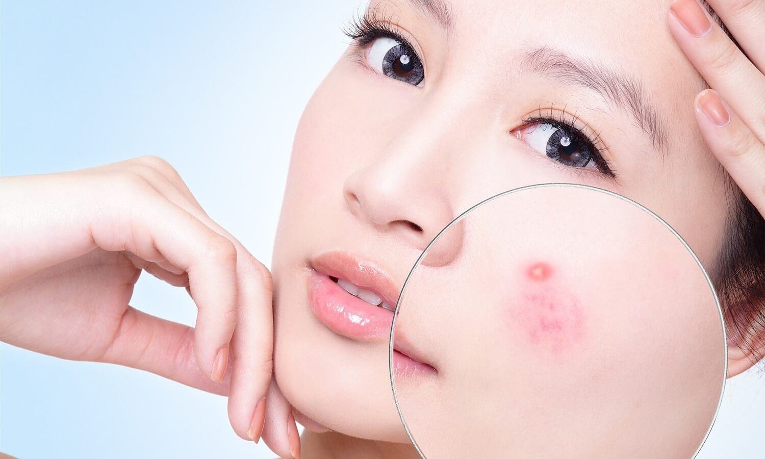 Exclusive Dermatological Acne Treatment Process at Miss Tram Special