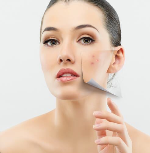 Beat Acne With Micro-Stimulation Technology Combined With Traditional Oriental Medicine Ideas
