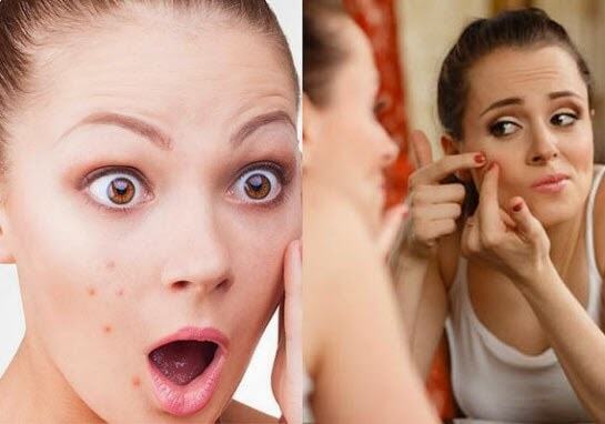 Top causes of acne