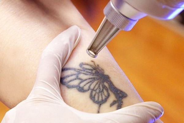Laser tattoo removal technology