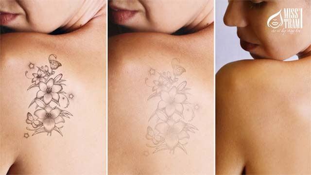 Safe tattoo removal without leaving scars