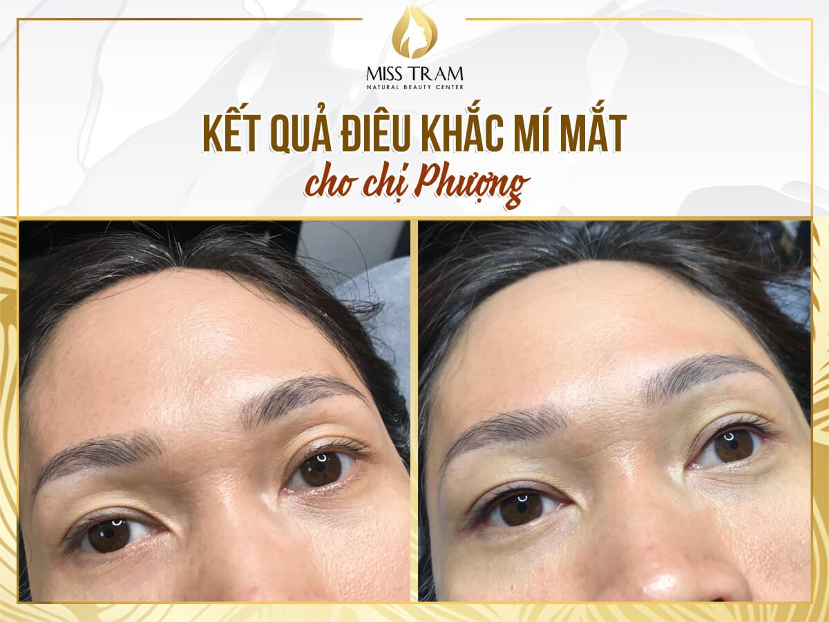 Beautiful Eyelid Sculpture Result Photo For Sister Phuong's Reference