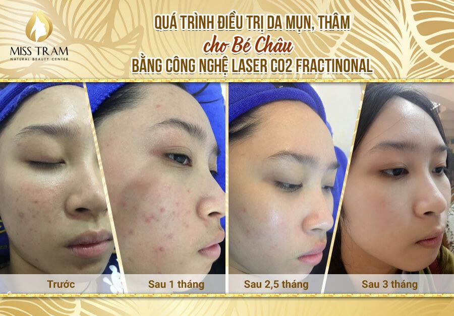 Advice on Acne Treatment Methods Suitable For Each Important Skin Type