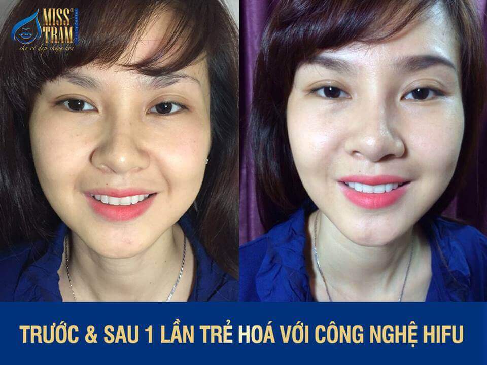 trẻ hóa da với công nghệ hifu