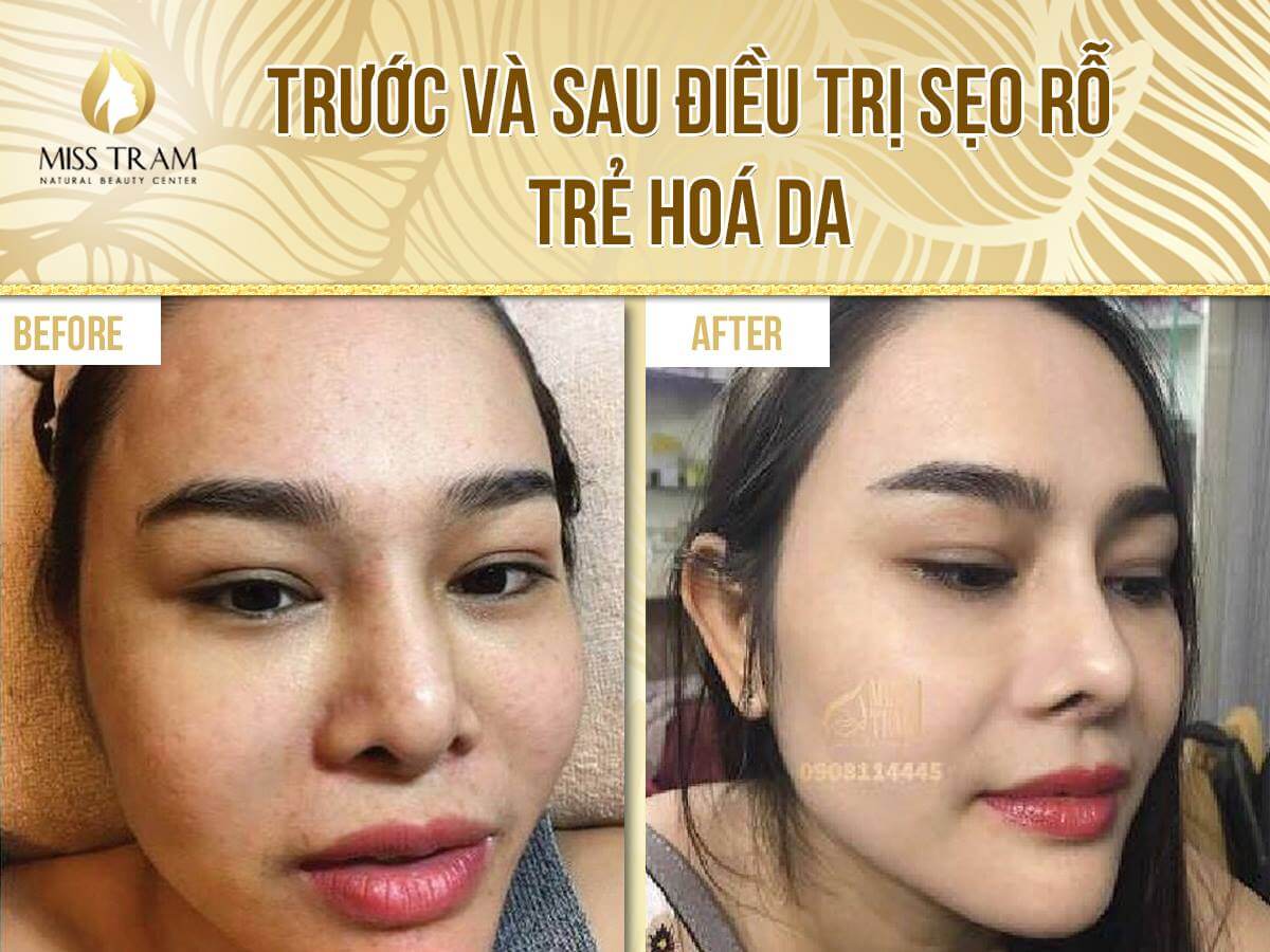 Trước và sau điều trị sẹo rỗ tại Spa Miss Tram