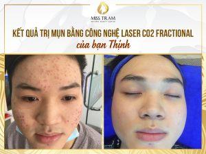 Kết Quả Điều Trị Mụn Bằng Công Nghệ Laser CO2 Fractional Cho Bạn Thịnh Phổ biến