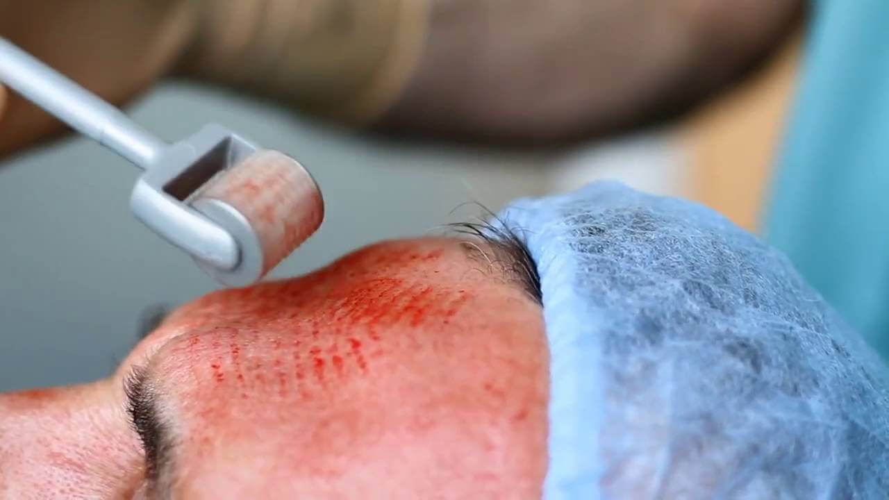 Is needle roller treatment for pitted scars really safe?