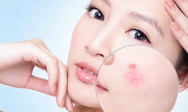 acne treatment under the skin