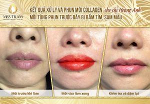Queen Collagen Lip Spray Results of Ms. Hoang Anh Captured
