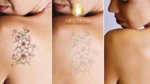 Scarless Tattoo Removal Service at Miss Tram Natural Beauty Center