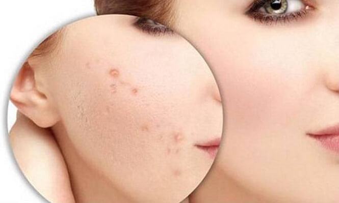Acne hidden under the skin - causes and treatment