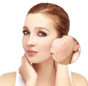 Beat Acne For More Radiant Skin Learn