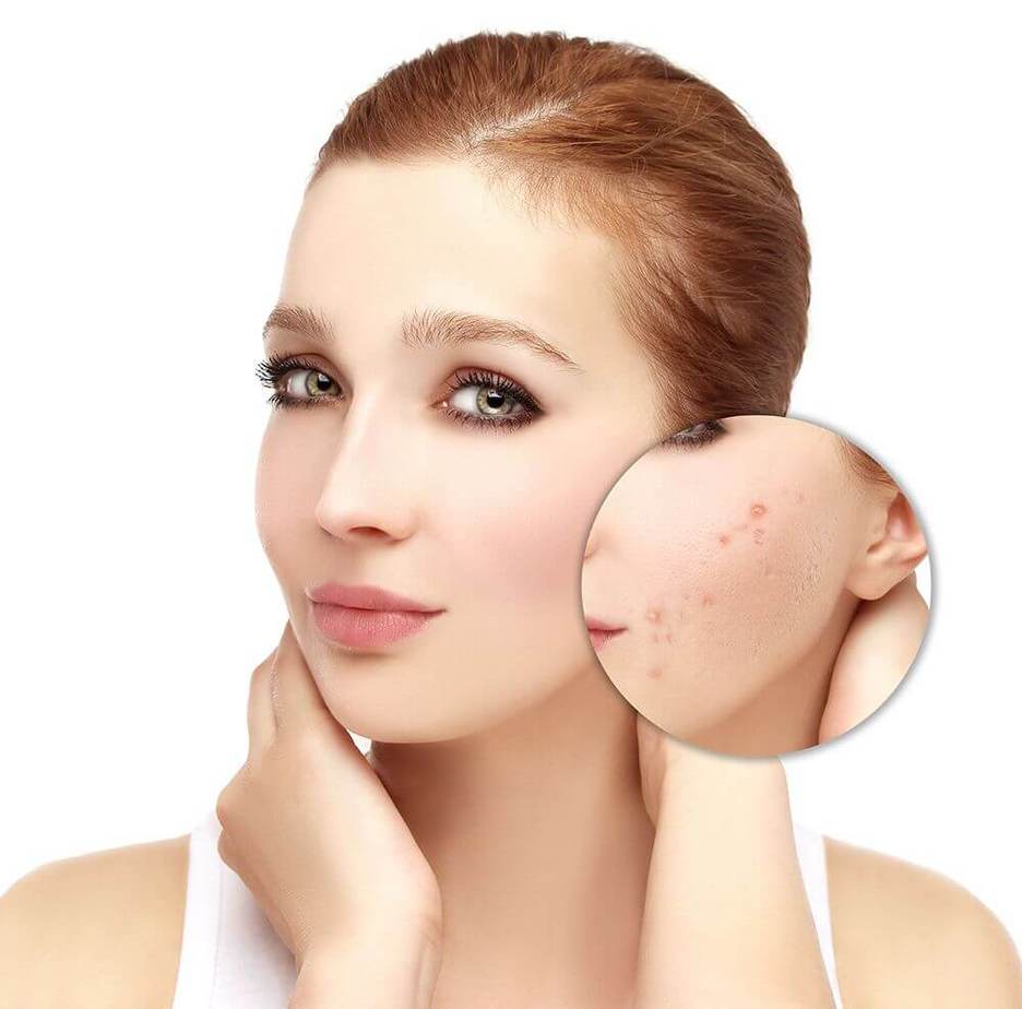 Beat Acne For More Radiance Directly