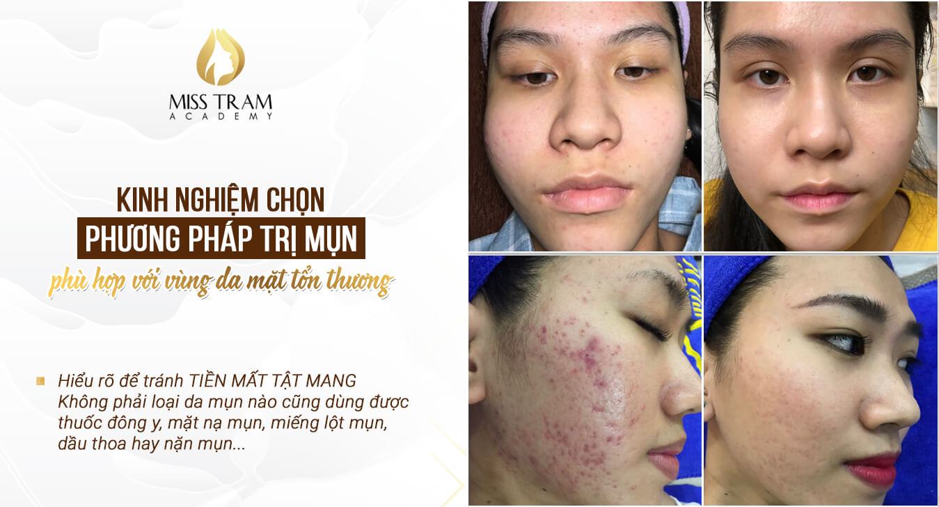Top 10 most prestigious acne beauty salons in Ho Chi Minh City - 5 best acne treatment addresses in HCMC today + reviews, price list
