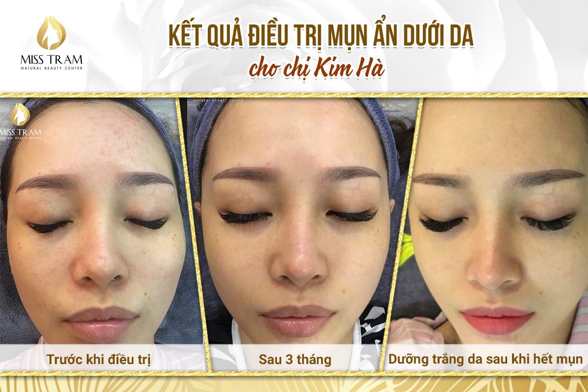 acne treatment results at spa