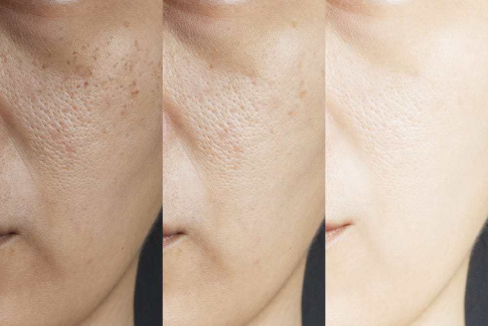 How to effectively tighten pores